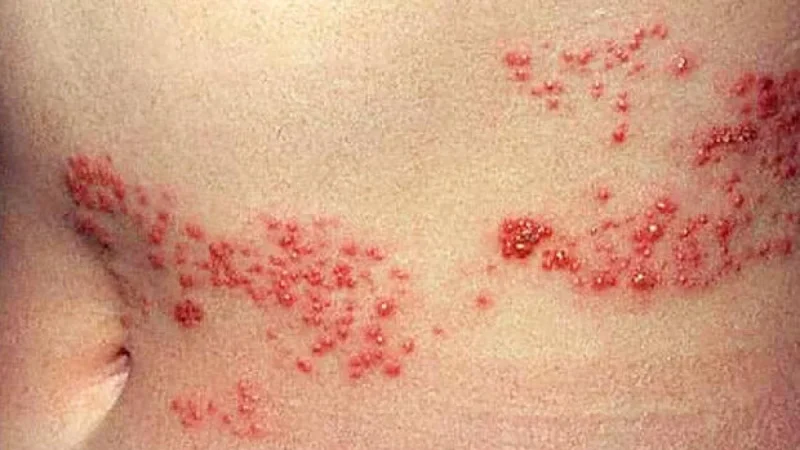 الوقاية أقصر طرق علاج ‘الحزام الناري’
